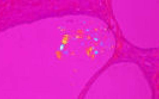 Normogram voor screeningsmammogram