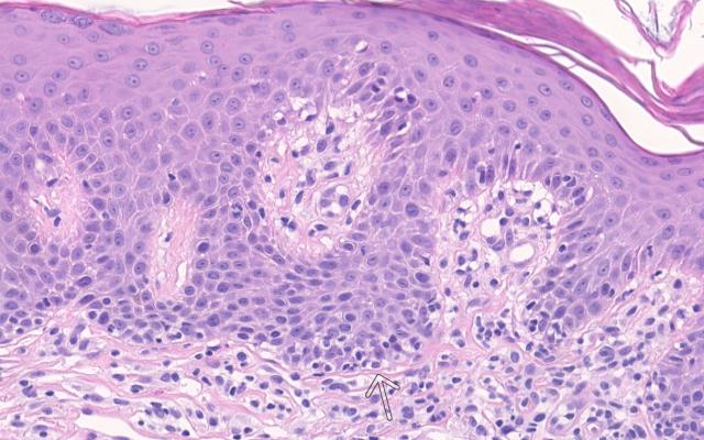Microscopisch beeld van een huidbiopt.