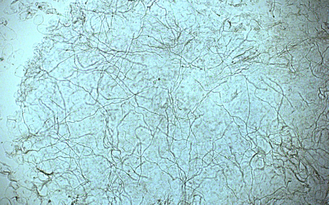 Schimmeldraden in KOH-preparaat.