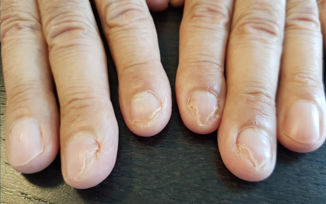 Brokkelige vingernagels.