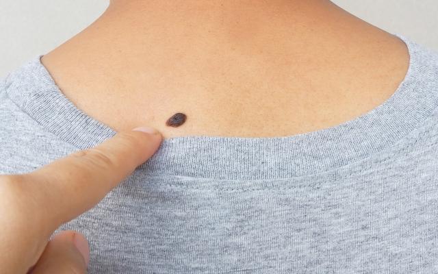 Een vinger die wijst naar een moedervlek 