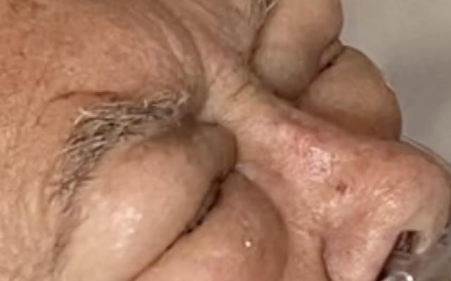 Een oude meneer met opgezwollen oogleden.