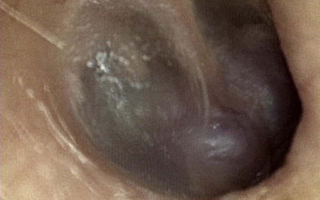 Trommelvlies ingezoomed.