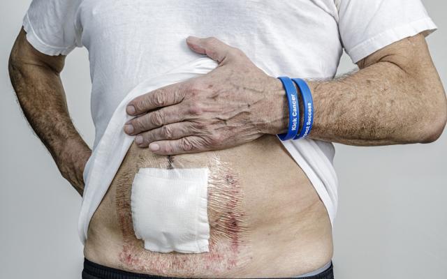 Foto van buik met operatieplijster erop