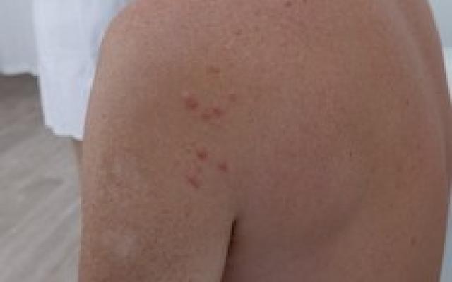 Schouder met huidafwijkingen erop