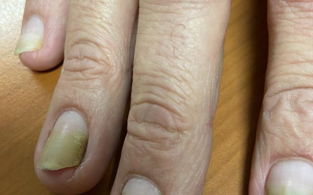 hand met gelige nagels