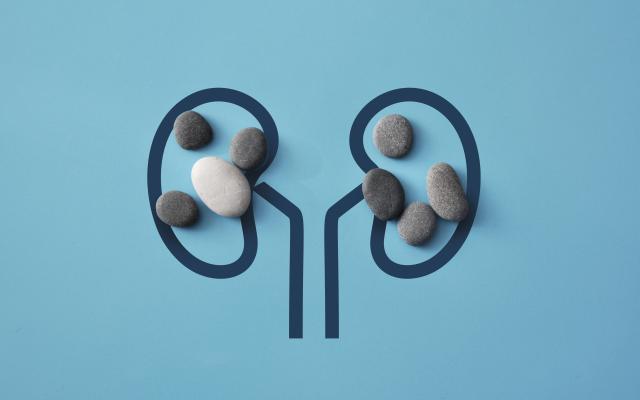 Illustratie van nieren met stenen erin