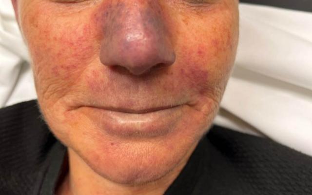 Vrouw met een paarsrode neus