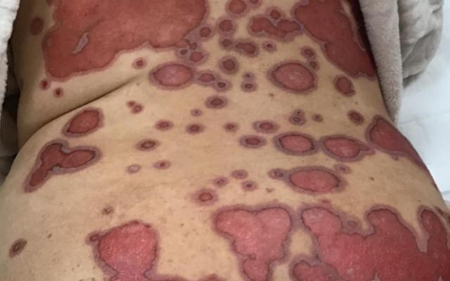 Huid met afwijkingen