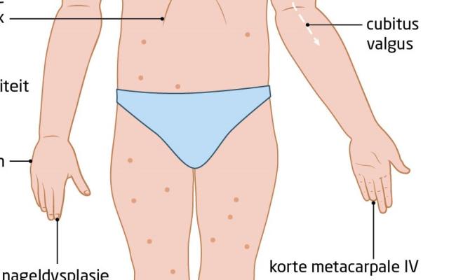 uitingsvormen van Turner-syndroom