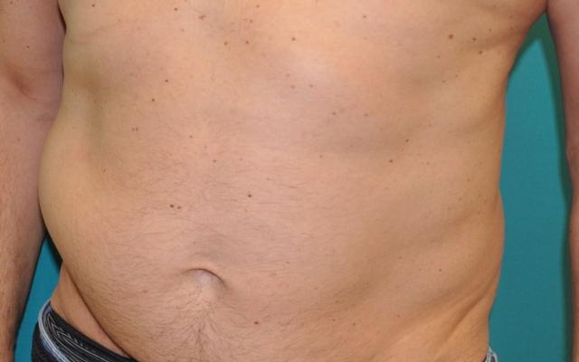 Uitstulping op de buik