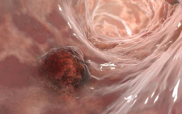 Tumor in de slokdarm