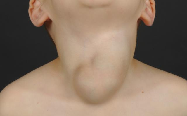 Jongen met zwelling in de hals