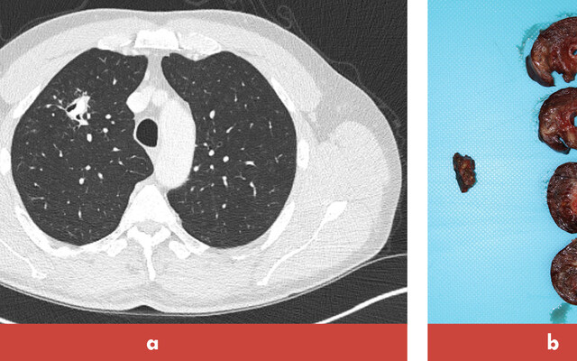 Beeld uit artikel Röntgen en biopt