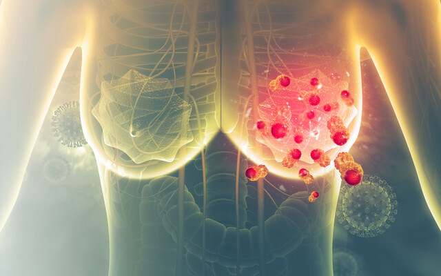 Borst met mammacarcinoom