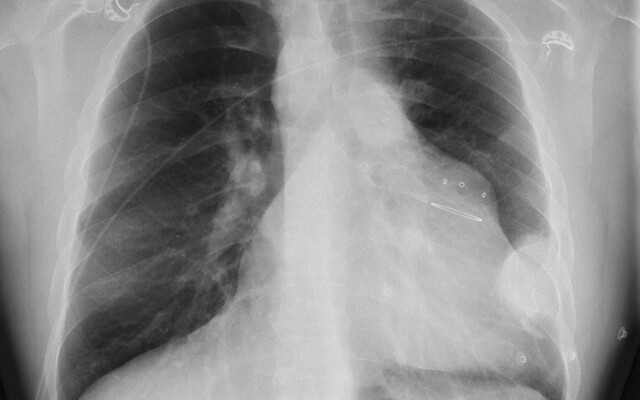 Röntgenbeeld van de borstkas