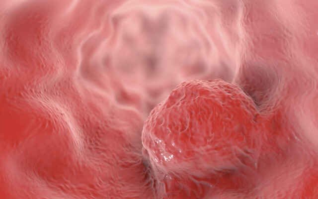 Tumor in de slokdarm