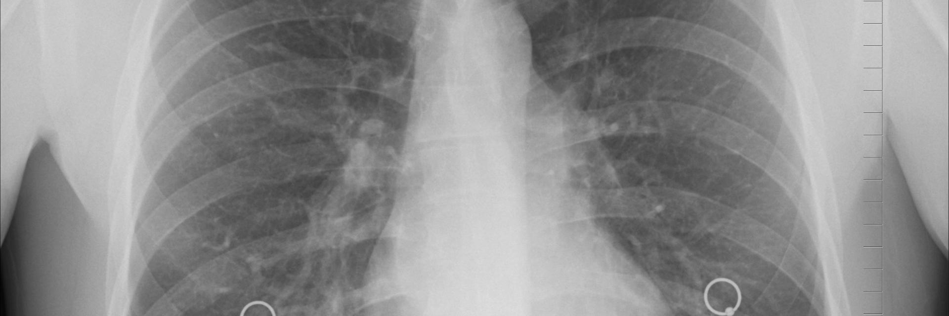 Radiologische scan van borstkas.