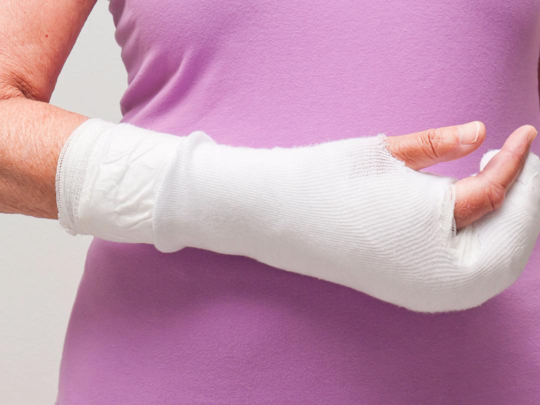 Een arm in het gips.