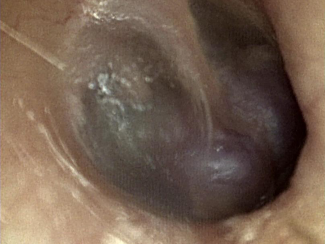 Trommelvlies ingezoomed.