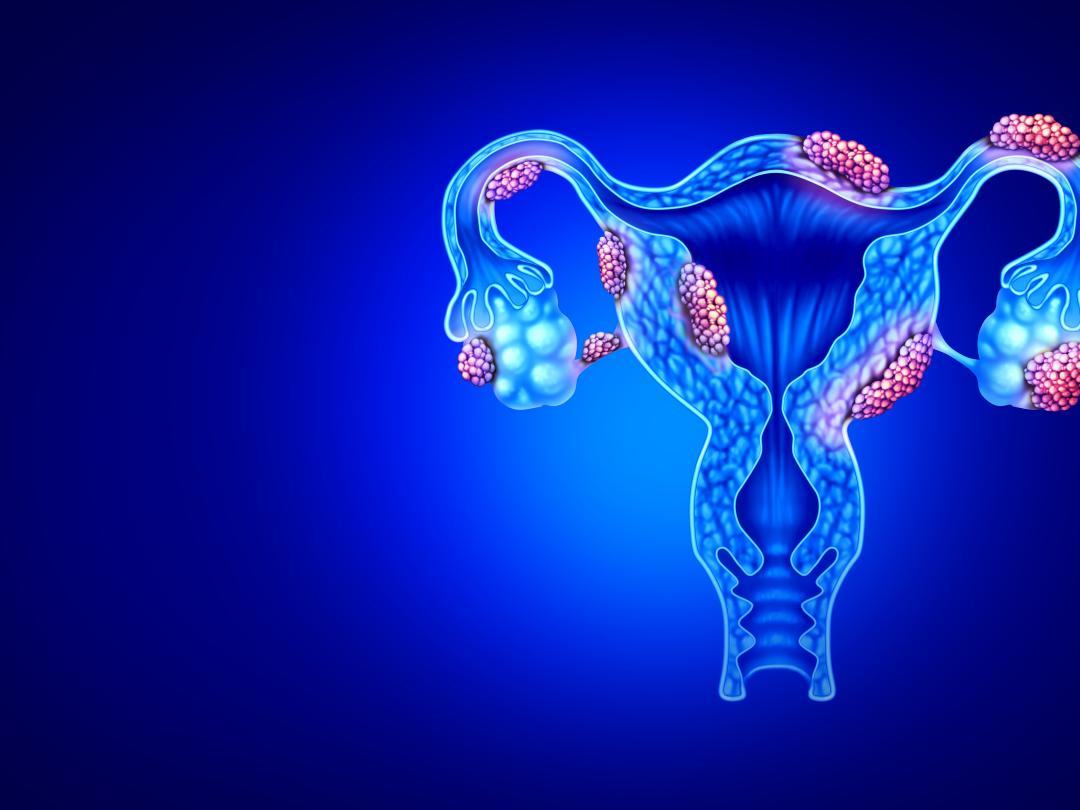 Illustratie van vrouwelijke geslachtsorganen me gezwellen erop