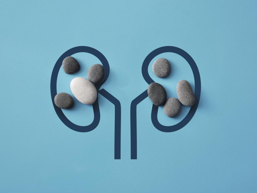 Illustratie van nieren met stenen erin