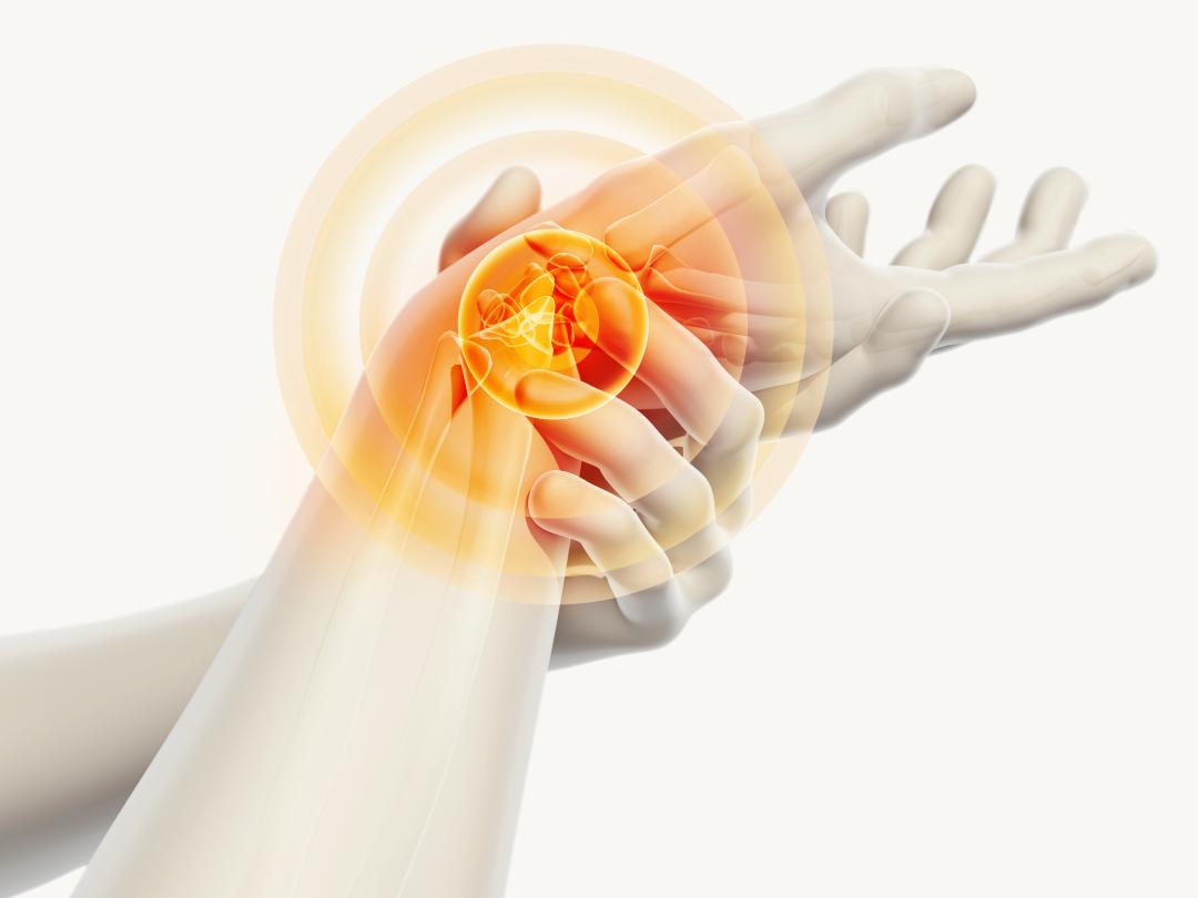 Illustratie van een pols met pijn