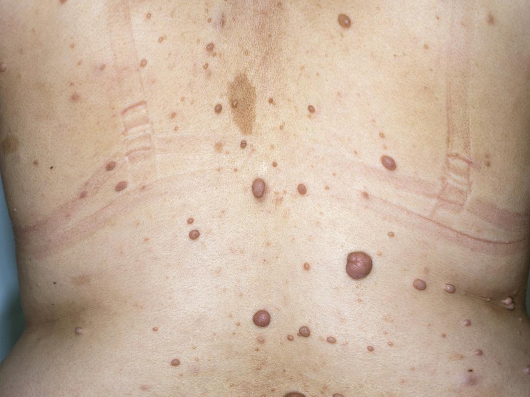 Rug met moedervlekken erop