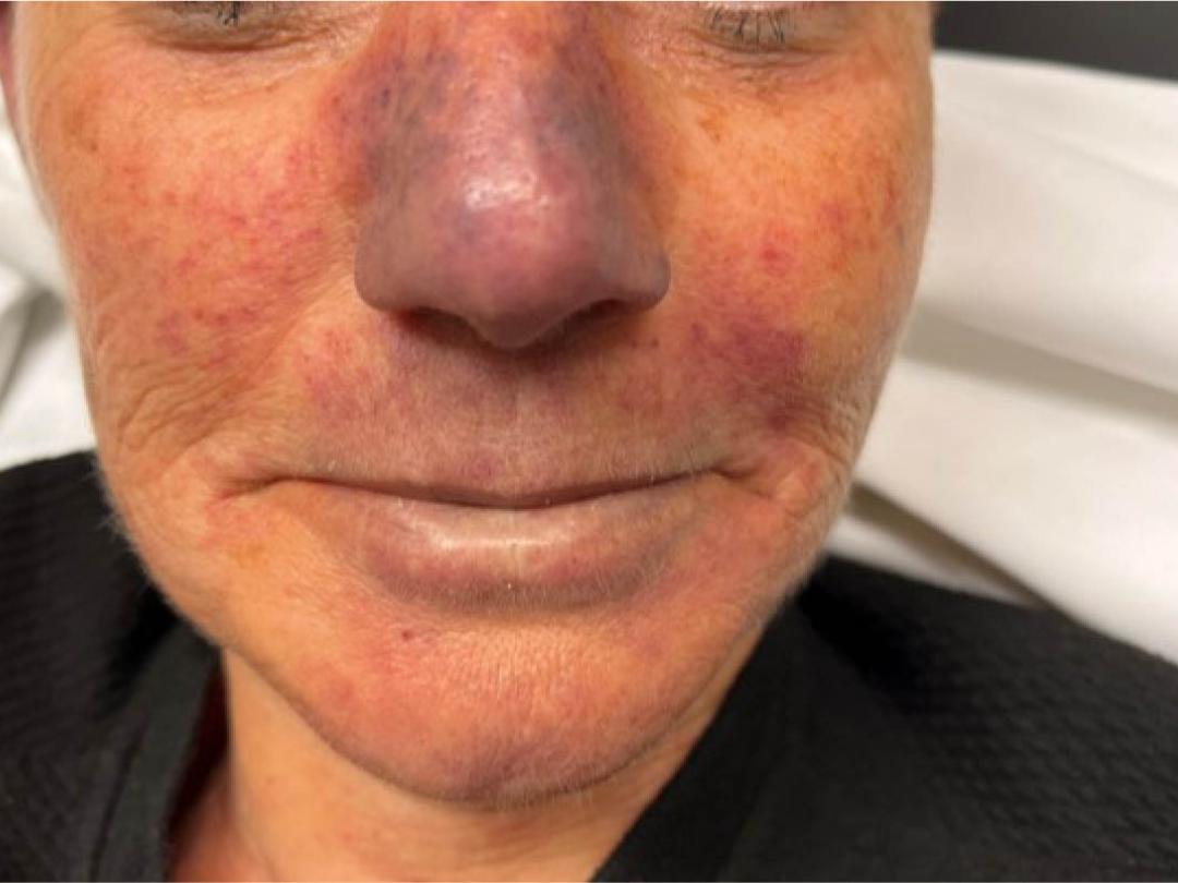 Vrouw met een paarsrode neus