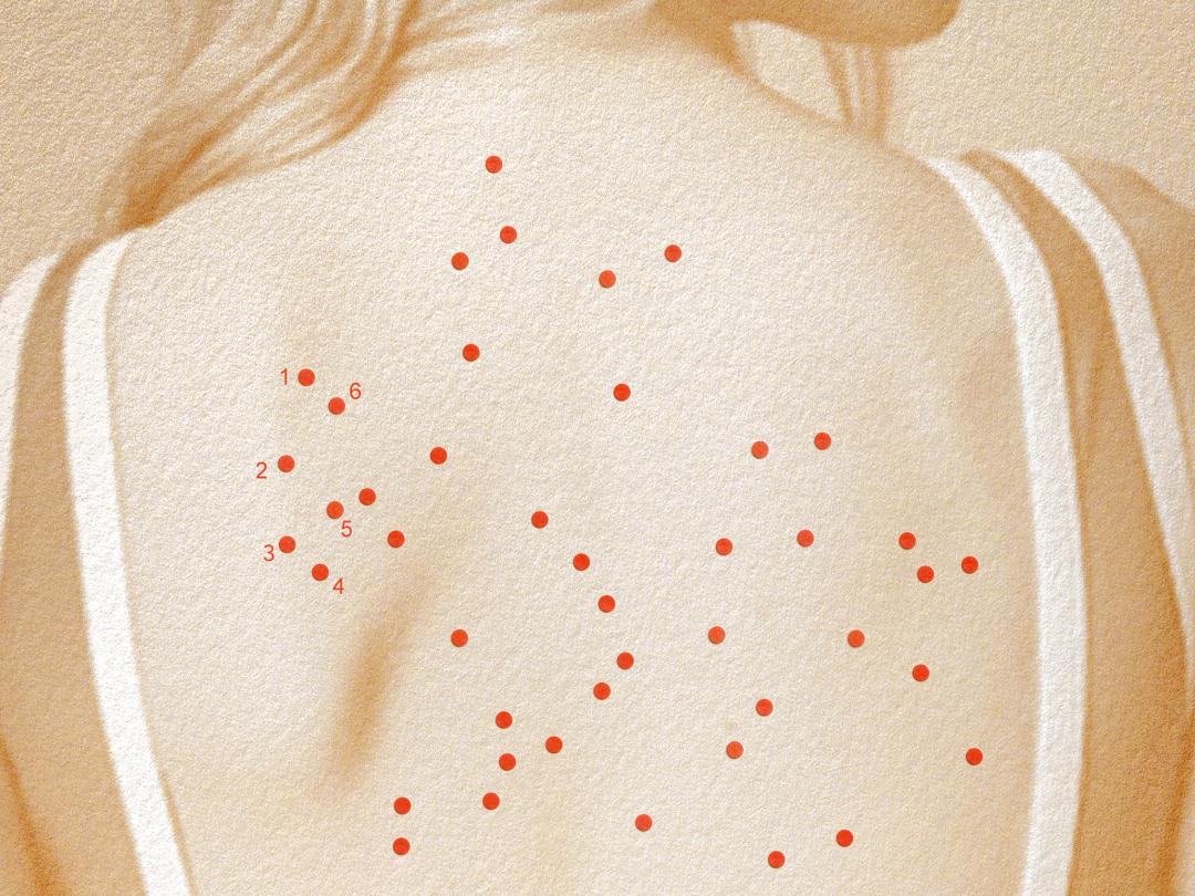 Een rug met uitslag erop