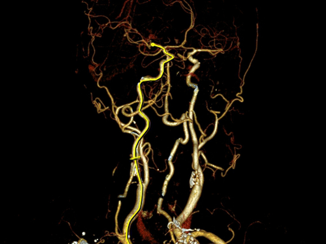 Illustratie van aderen in hoofd