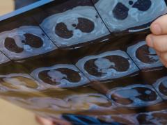 Iemand houdt een set radiologische beelden vast.