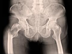 Röntgen van het bekkengebied