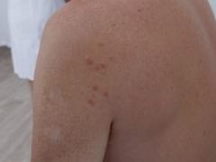 Schouder met huidafwijkingen erop