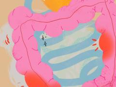 Illustratie van een ontstoken darm