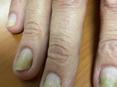 hand met gelige nagels