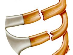 Illustratie van gebroken ribben