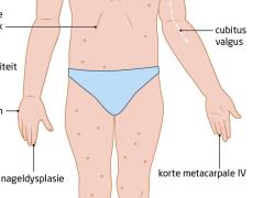 uitingsvormen van Turner-syndroom