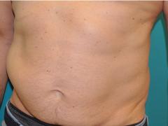 Uitstulping op de buik