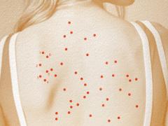 Een rug met uitslag erop