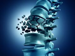 Illustratie van een wervelkolom met één gebroken wervel