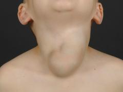 Jongen met zwelling in de hals