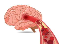 Illustratie van de binnenkant van een ader met propjes erin