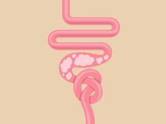 Illustratie van een darmkanaal met een knoop erin.