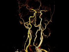 Illustratie van aderen in hoofd