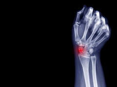 Röntgenfoto van pols