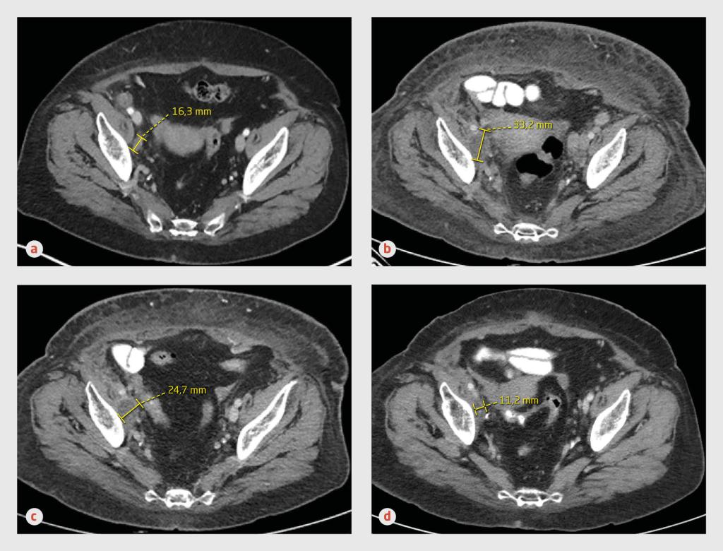 Figuur 1 | Pseudoprogressie bij patiënt A