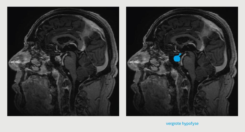 Figuur | Hypofysitis