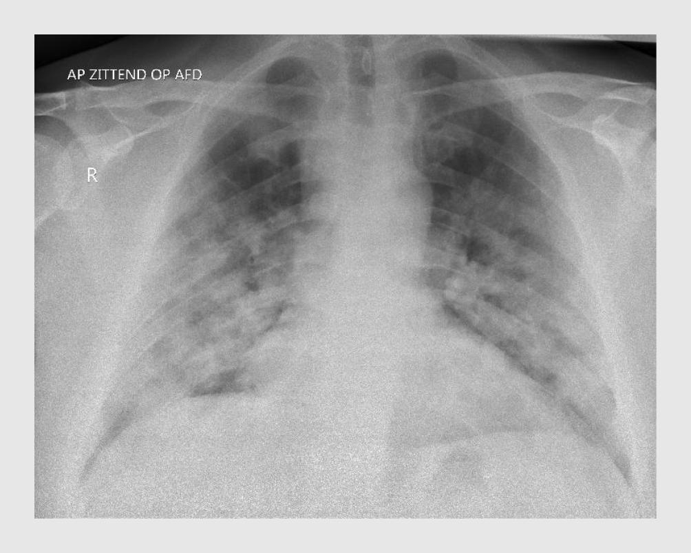 Figuur 1 | Thoraxfoto van een patiënt met COVID-19