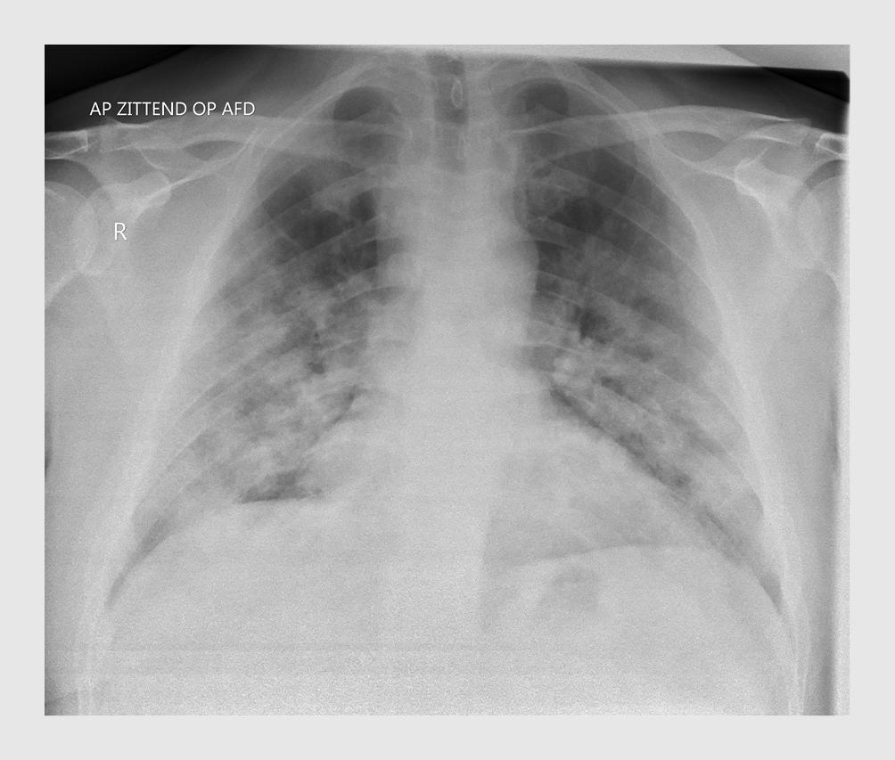 Figuur 1 | Afwijkingen op longfoto bij COVID-19
